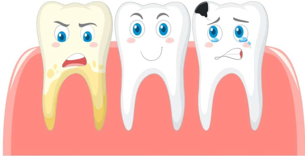 What Causes Cavities and Tooth Decay