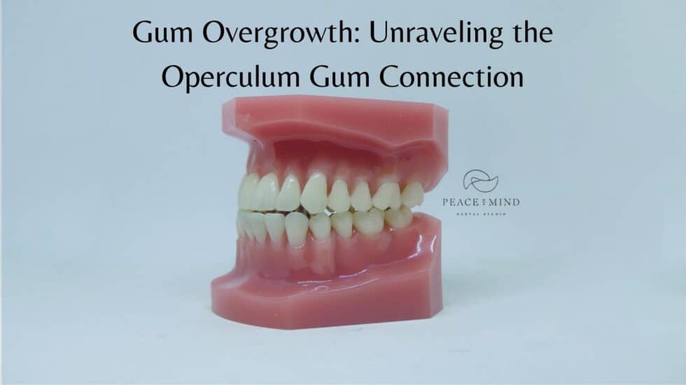 Gum Overgrowth: Unraveling the Operculum Gum Connection